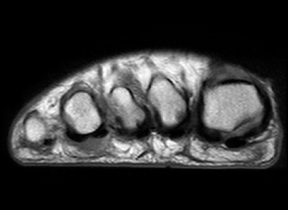 Figure 2 for case Advential bursitis